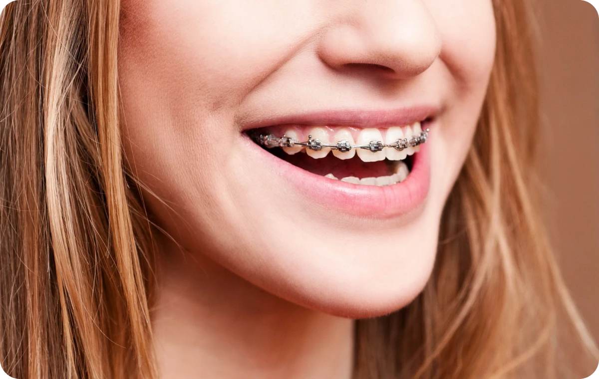 appareils dentaires biarritz metal ceramique appareils dentaires biarritz metal ceramique Appareils dentaires en métal et céramique Dr Loustau-Dessus