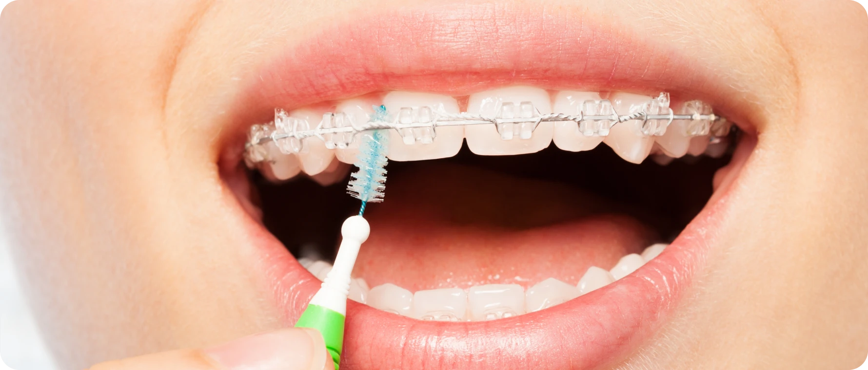 appareils dentaires metal biarritz enfants appareils dentaires metal biarritz enfants Appareils dentaires (métal et céramique) Dr Loustau-Dessus