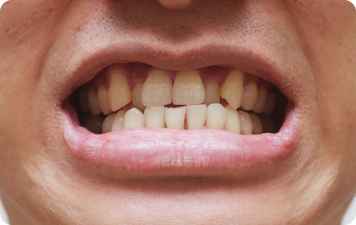 appareils dentaires metal biarritz orthodontie appareils dentaires metal biarritz orthodontie Traitement par gouttières invisibles Dr Loustau-Dessus