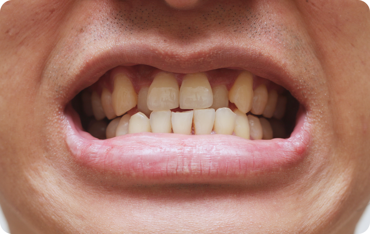 cabinet dentaire biarritz chevauchement dentaire cabinet dentaire biarritz chevauchement dentaire Dents qui se chevauchent Dr Loustau-Dessus