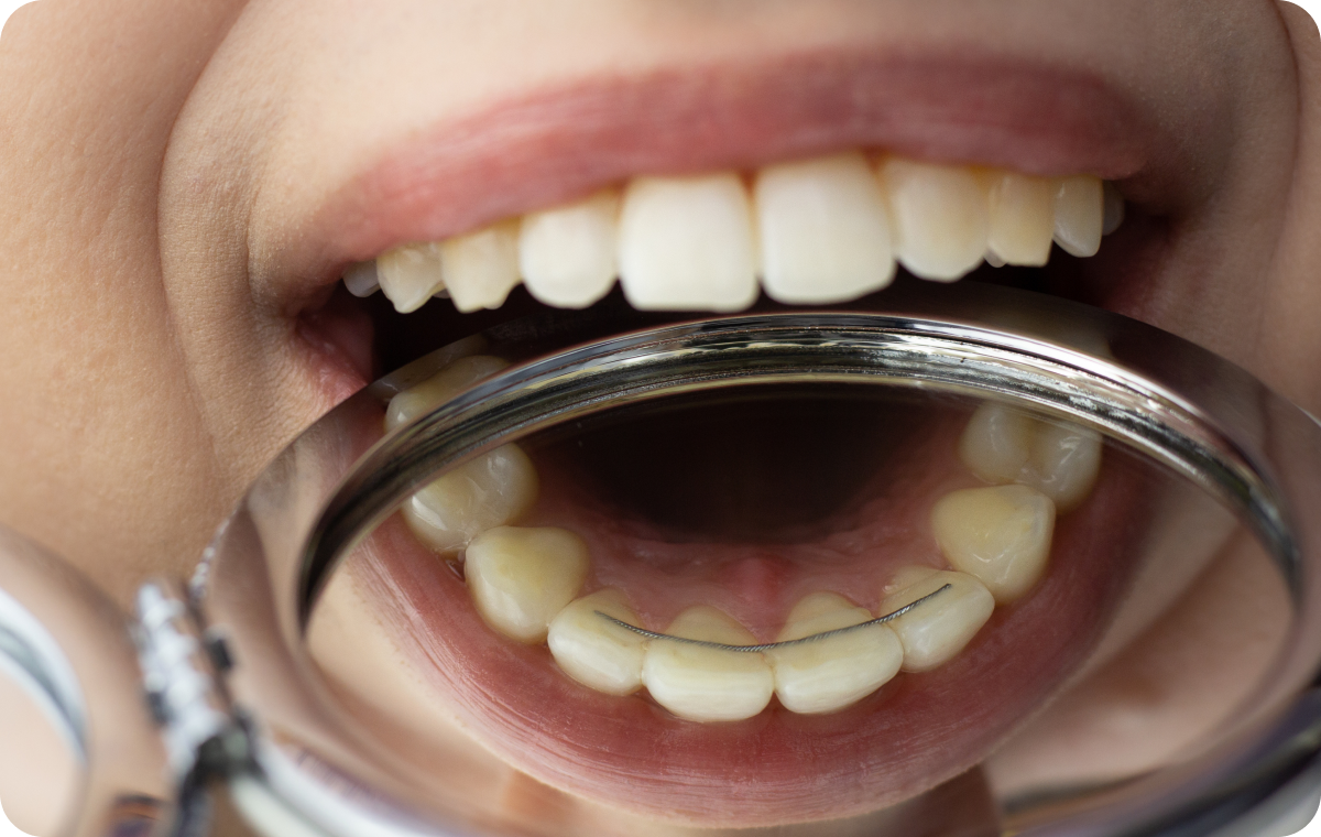 contention biarritz appareil orthodontie contention biarritz appareil orthodontie Contention Dr Loustau-Dessus