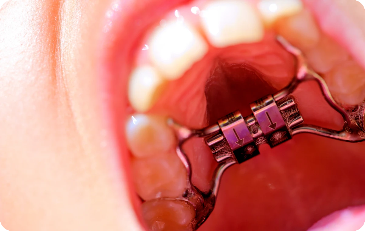 disjoncteur maxillaire biarritz chevauchement dentaire disjoncteur maxillaire biarritz chevauchement dentaire Disjoncteur maxillaire Dr Loustau-Dessus