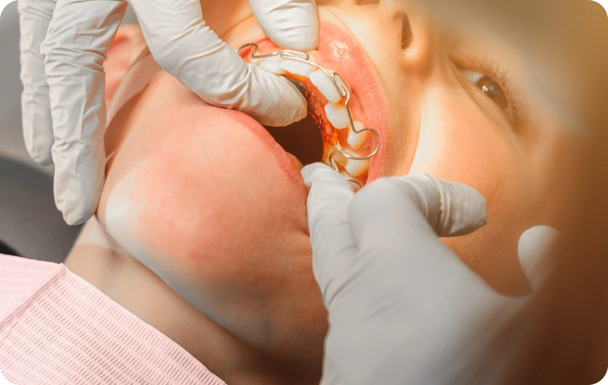 disjoncteur maxillaire biarritz orthodontie adultes disjoncteur maxillaire biarritz orthodontie adultes Activateur (classe 2 et classe 3) Dr Loustau-Dessus