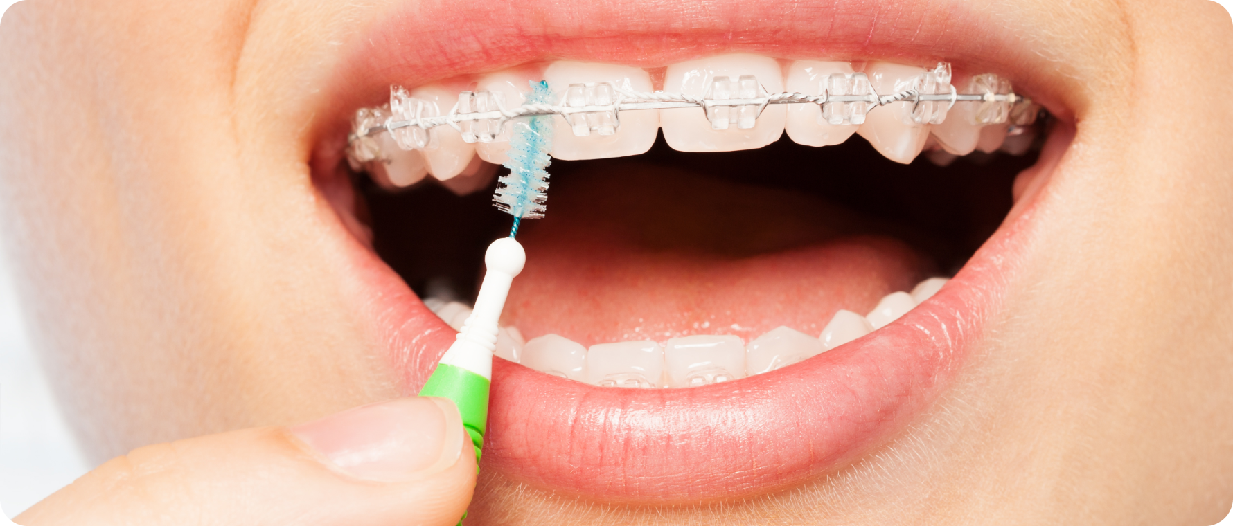 dr loustau dessous biarritz hygiene bucco dentaire dr loustau dessous biarritz hygiene bucco dentaire Alimentation avec un appareil dentaire Dr Loustau-Dessus