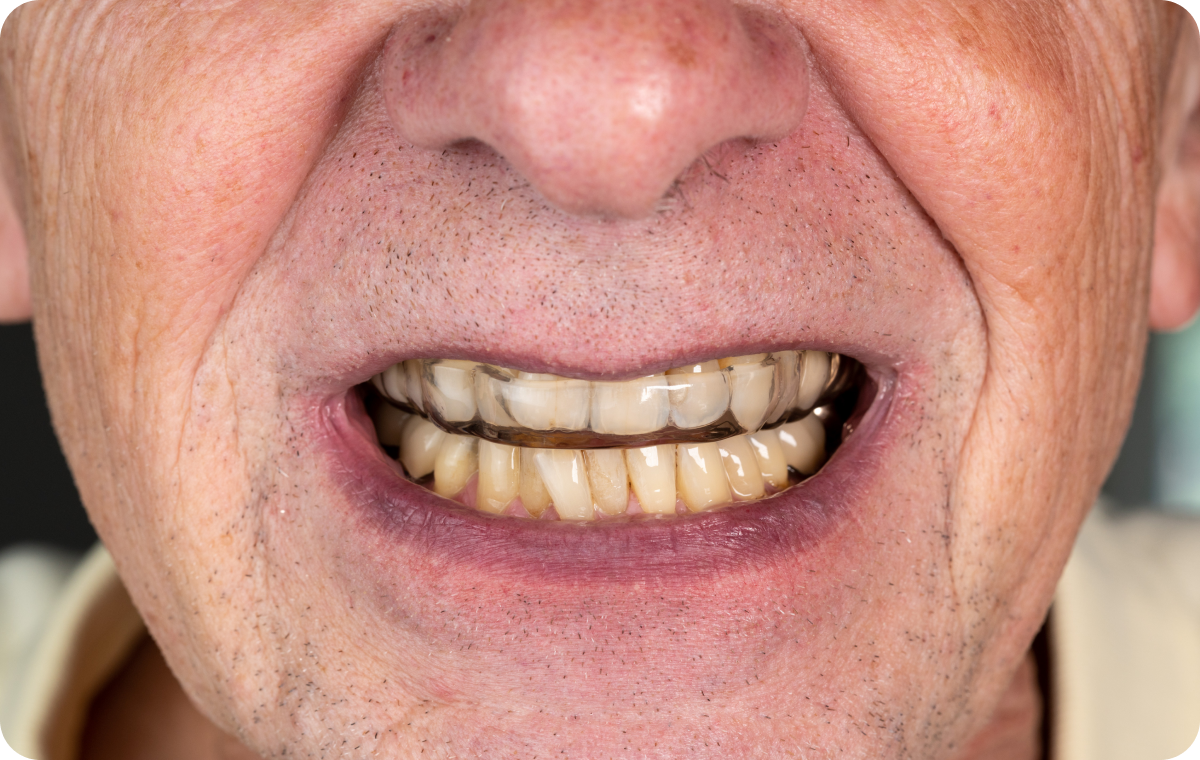 gouttieres invisibles biarritz orthodontie seniors gouttieres invisibles biarritz orthodontie seniors Traitement par gouttières invisibles Dr Loustau-Dessus