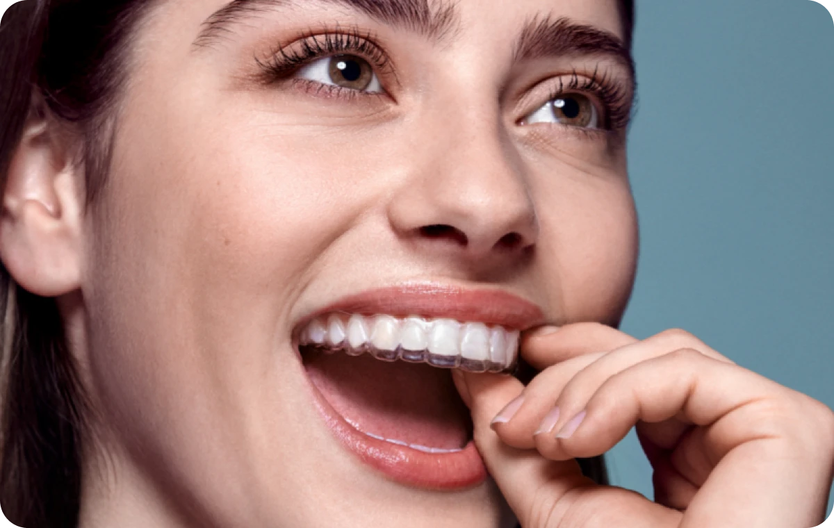 gouttiers dr loustau dessus gouttiers dr loustau dessus Traitement par gouttières invisibles Dr Loustau-Dessus