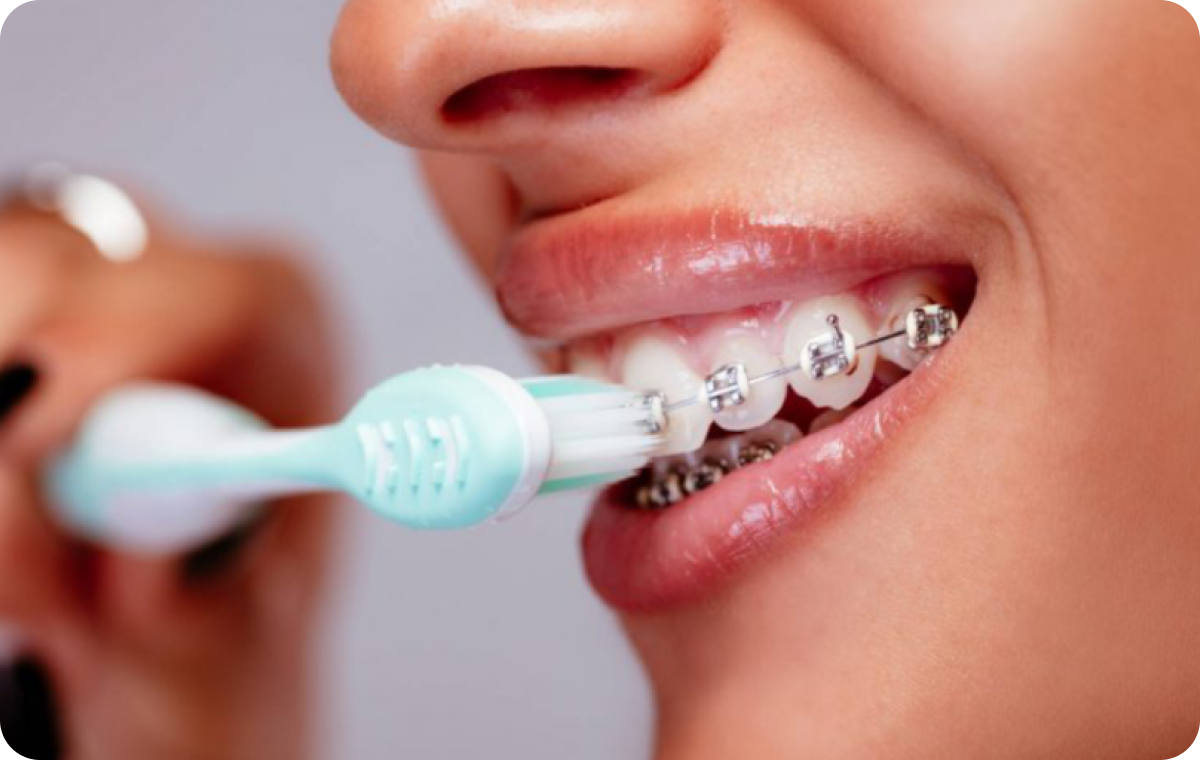 hygiene bucco dentaire biarritz appareils Appareils dentaires Dr Loustau-Dessus