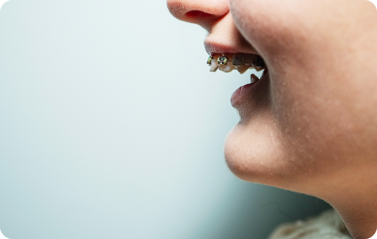 orthodontie adolescents biarritz pluridisciplinaire orthodontie adolescents biarritz pluridisciplinaire Mâchoire en arrière Dr Loustau-Dessus