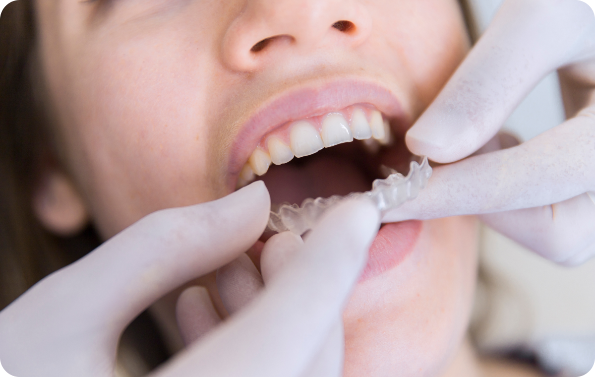 orthodontiste biarritz gouttieres orthodontiste biarritz gouttieres Dents qui se chevauchent Dr Loustau-Dessus