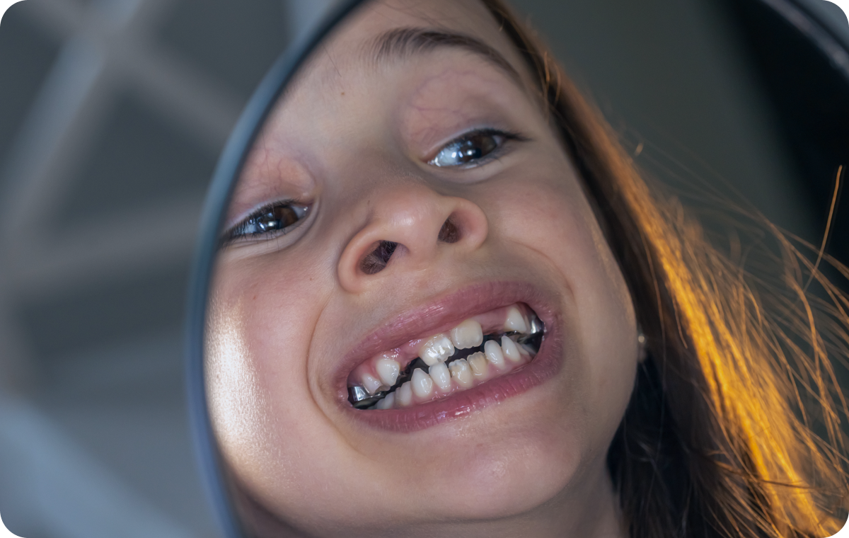 traitement pluridisciplinaire biarritz orthodontie traitement pluridisciplinaire biarritz orthodontie Activateur (classe 2 et classe 3) Dr Loustau-Dessus