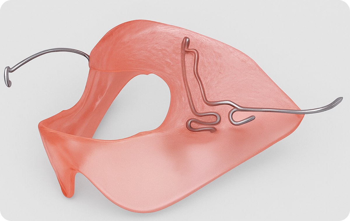 traitement pluridisciplinaire biarritz plaque hawley traitement pluridisciplinaire biarritz plaque hawley ELN (enveloppe linguale nocturne) Dr Loustau-Dessus